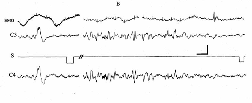 Stages of Sleep EEG