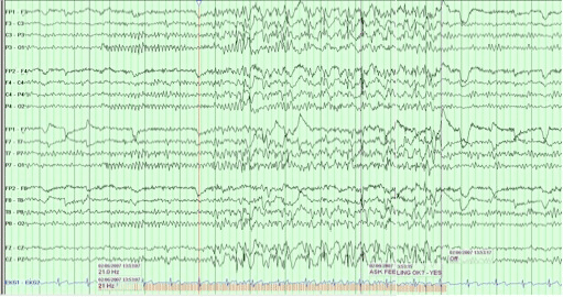 EEG Photic Stimulation